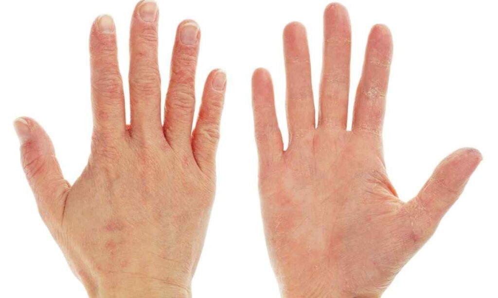 Дерматит рук - Які прчини, профілактика та лікування дерматиту рук?
