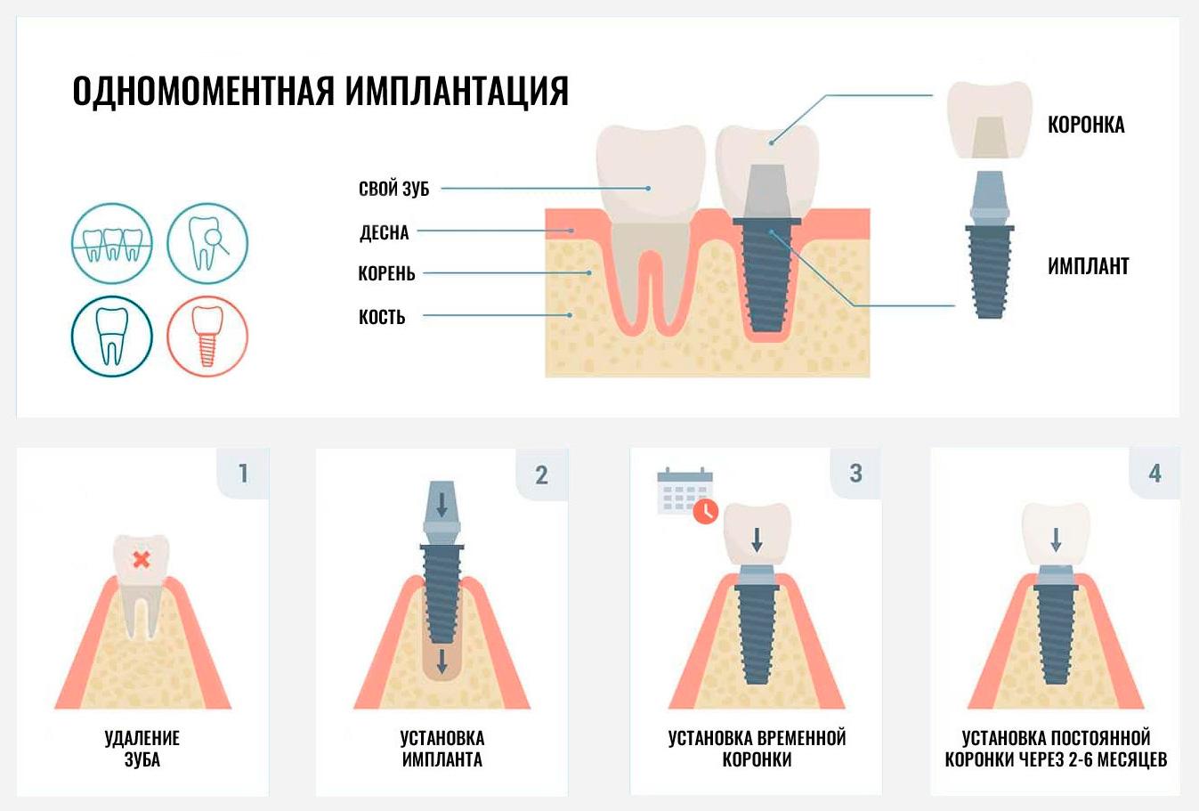 Одномоментная имплантация зуба: показания, противопоказания, этапы