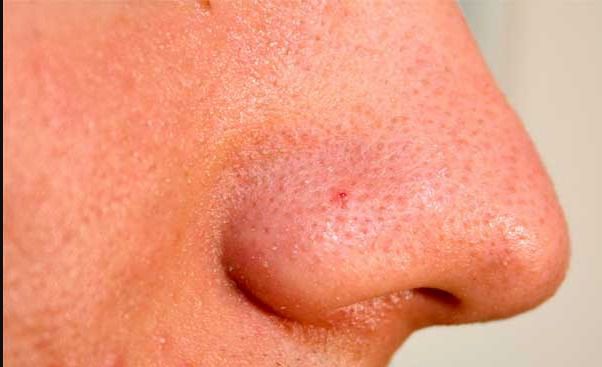 Розширені пори носи - Як очистити розширені пори носа?