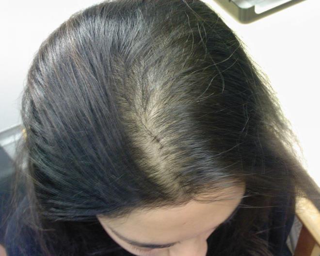 Випадання волосся - Які є типи випадання волосся у жінок?