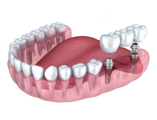 Плюсы протезирования зубов в современной клинике