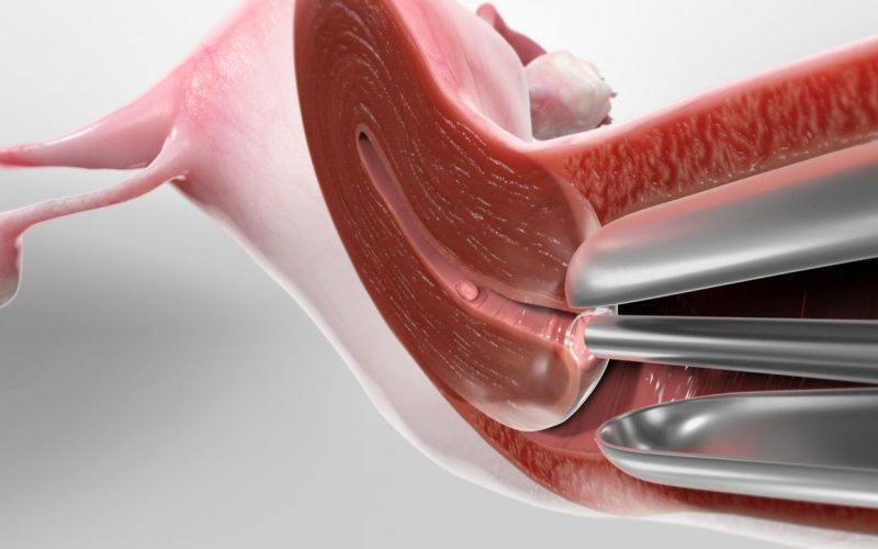 Гістероскопія у Києві при безплідді: сучасні методи обстеження та лікування